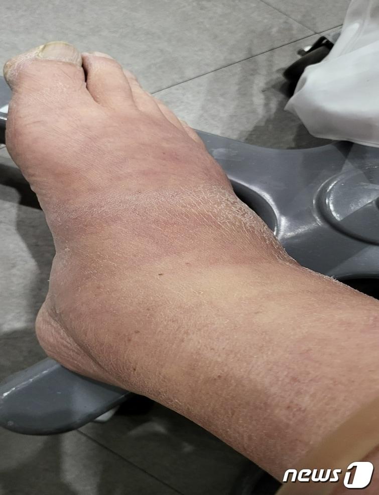 본문 이미지 - 패혈증을 앓는 A씨의 다리가 크게 부어 있다.(A씨 측 제공)