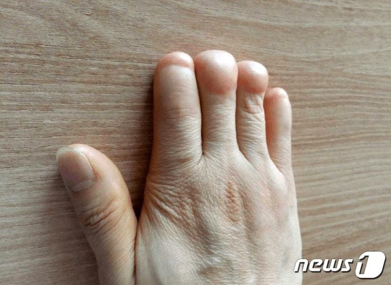 본문 이미지 - '절단된 손가락'.(전국학교비정규직노동조합 제주지부 제공)