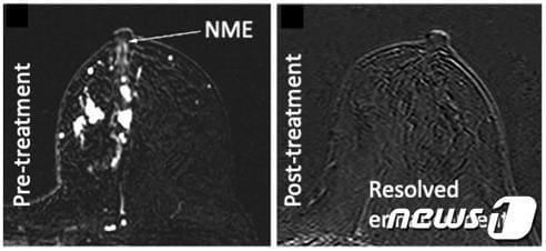본문 이미지 - 선행항암화학요법 전후 유방 MRI에서의 비종괴성 조영 증강 변화(강남세브란스병원 제공)