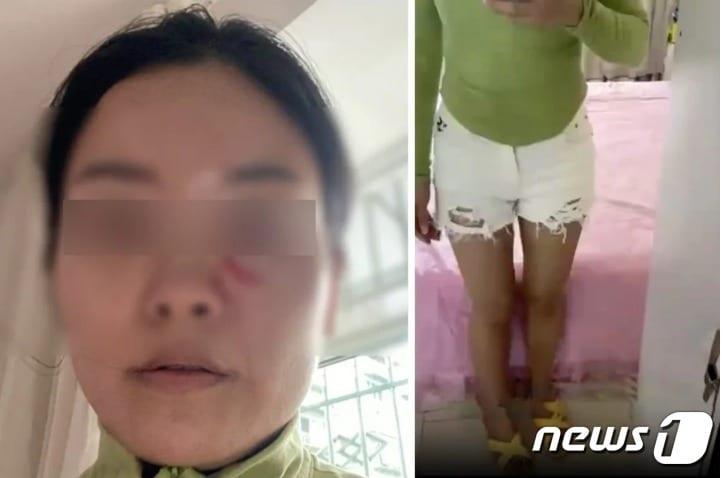 본문 이미지 - 뜨거운 국물로 눈밑에 화상을 입었다(왼쪽). 오른쪽은 핫팬츠 착용 사진 - SCMP 갈무리