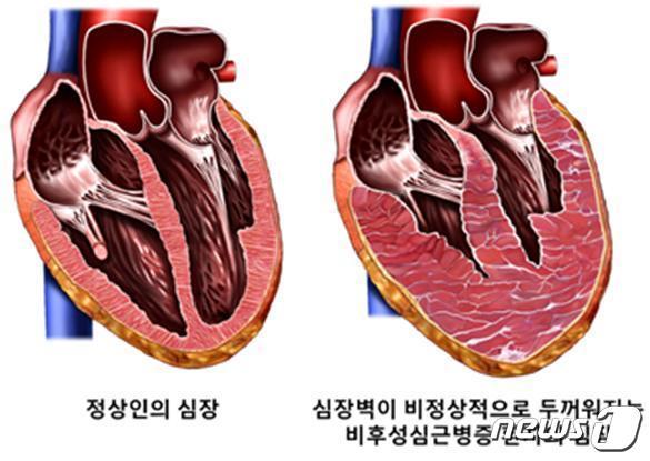 본문 이미지 - 비후성심근증 모식도(서울대병원 제공)