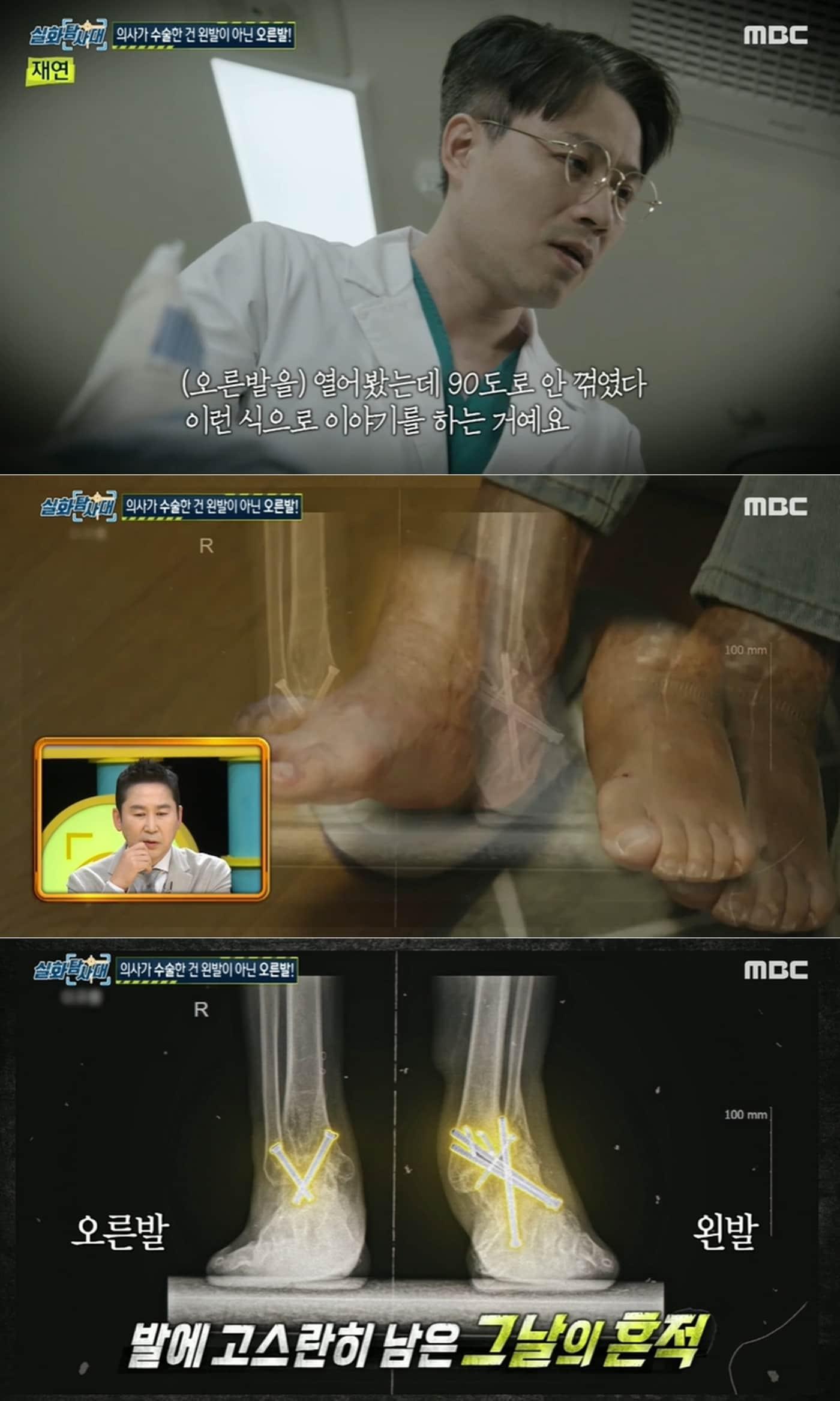 본문 이미지 - 서울의 한 유명 병원에서 20대 남성 환자의 다친 왼발을 두고 멀쩡한 오른발을 수술한 황당한 의료사고가 발생한 것으로 전해졌다. 실화탐사대 발송 화면 갈무리