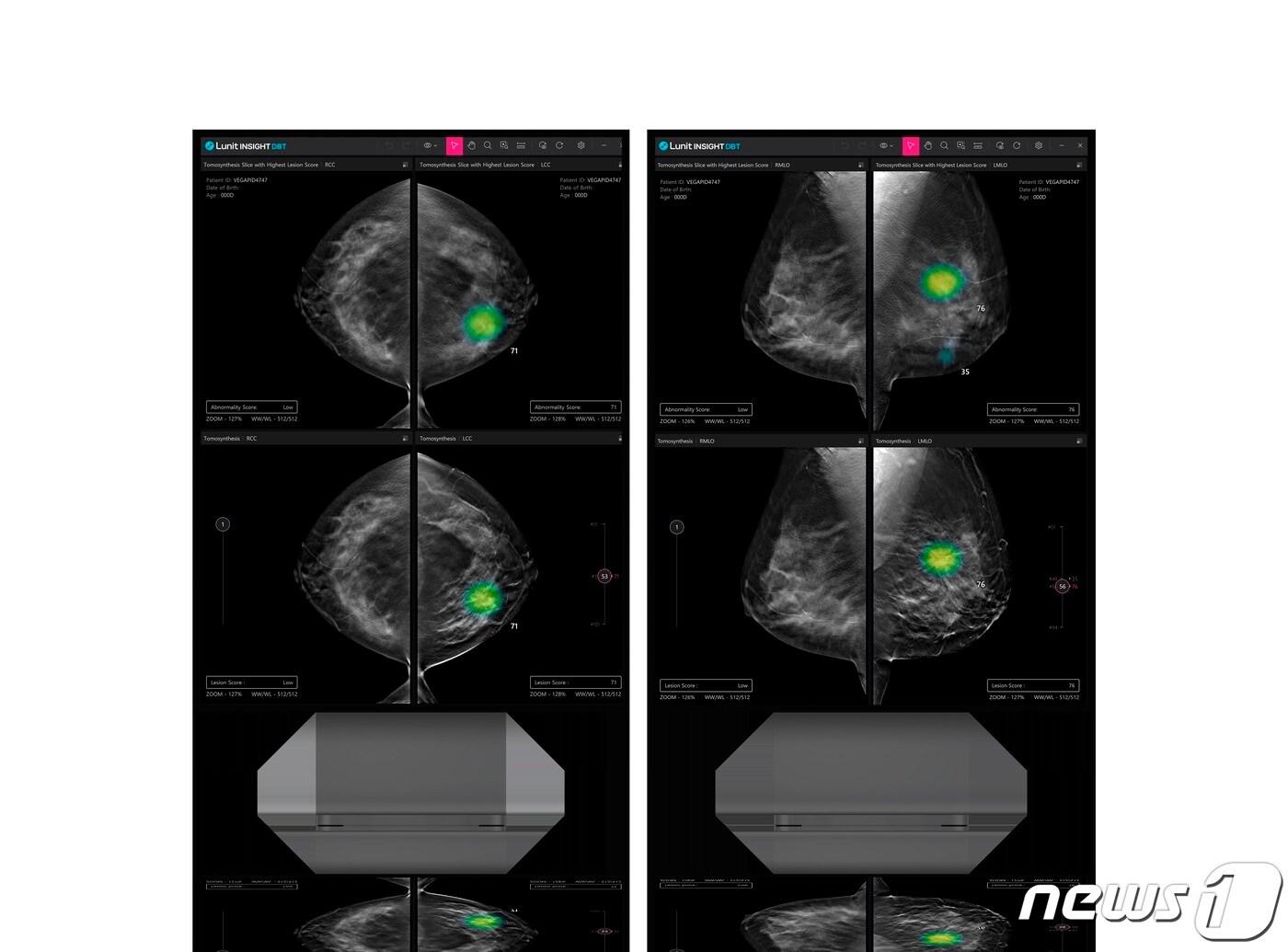 본문 이미지 - 루닛 인사이트 DBT 사용 장면/루닛 제공