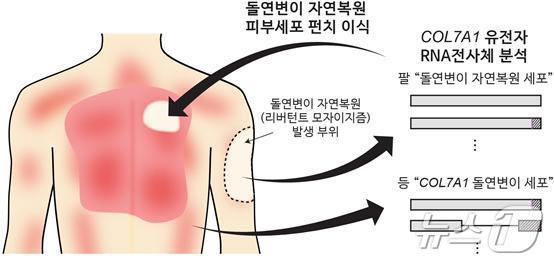 본문 이미지 - RDEB 환자 대상 유전자 돌연변이 자연 복원 피부세포 자가이식 치료 과정 모식도/강남세브란스병원 제공