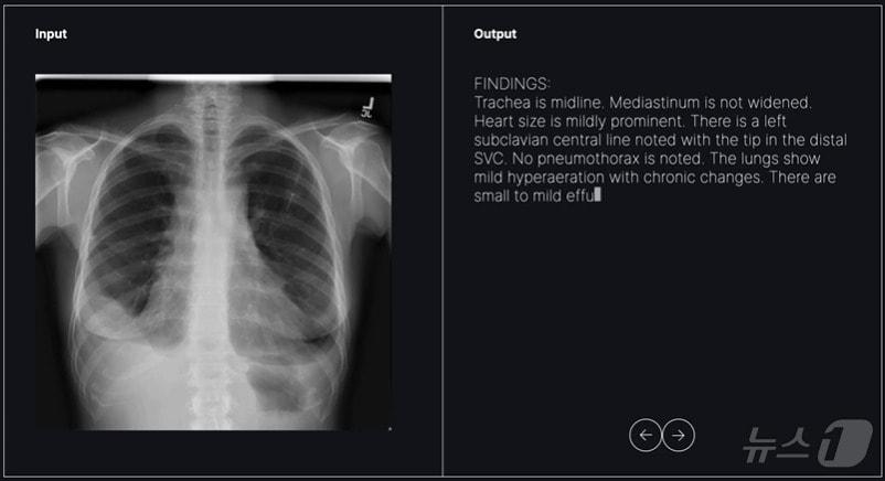 본문 이미지 - 숨빗AI가 개발 중인 영상의학과용 초기 판독문 생성 솔루션 'AI리드-CXR' 활용 모습.(숨빗AI 제공)/뉴스1 ⓒ News1