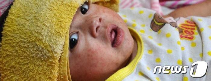 본문 이미지 - 시카고시에서 급증 추세를 보이는 홍역 환자가 한인들이 많이 사는 쿡 카운티에서도 처음 보고됐다. 시카고를 포함해 일리노이 전체 홍역 확진자 수는 미국 전체 홍역 환자의 절반 이상에 달한다. 보건 당국에 비상이 걸렸다. &#40;시카고공중보건부 제공&#41;