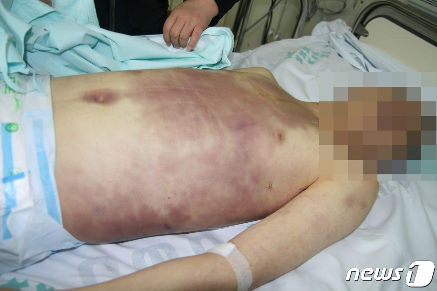  고(故) 윤 모 일병 사망 당시 온몸에 멍이 가득했다. (군인권센터 제공)