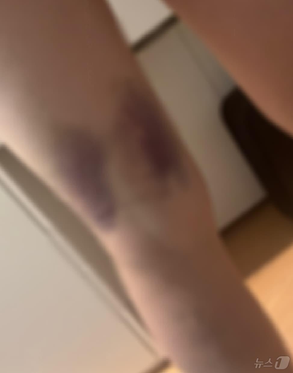 본문 이미지 - 지난 1월 7일 부산 부산진구 한 오피스텔에서 추락해 숨진 20대 여성 A씨가 생전 전 남자친구인 B씨에게 폭행을 당한 피해모습.(유족 제공)