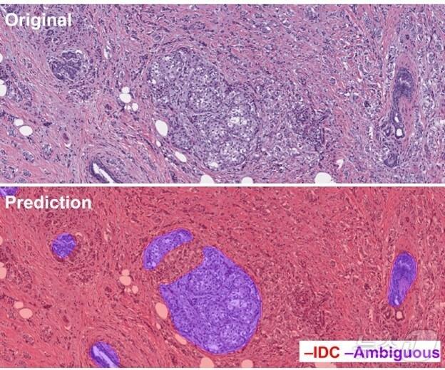 본문 이미지 - 딥바이오 유방암AI분석 알고리즘 모델 이미지/뉴스1