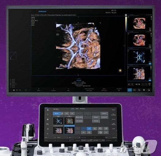 본문 이미지 - 삼성메디슨 AI 의료기기 활용 모습.(삼성메디슨 제공)/뉴스1 ⓒ News1