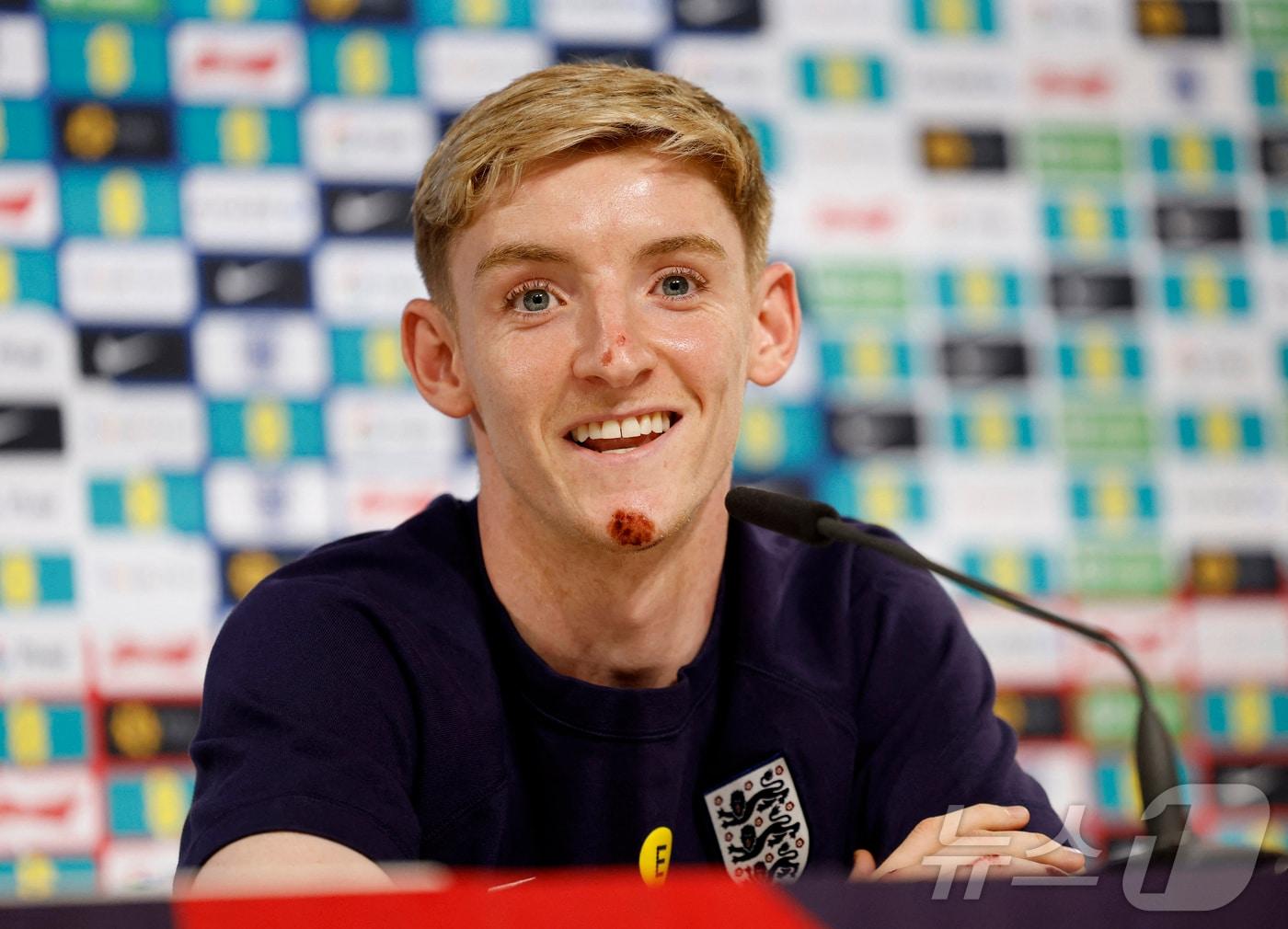 본문 이미지 - 코와 턱에 큰 상처가 생긴 앤서니 고든 ⓒ 로이터=뉴스1