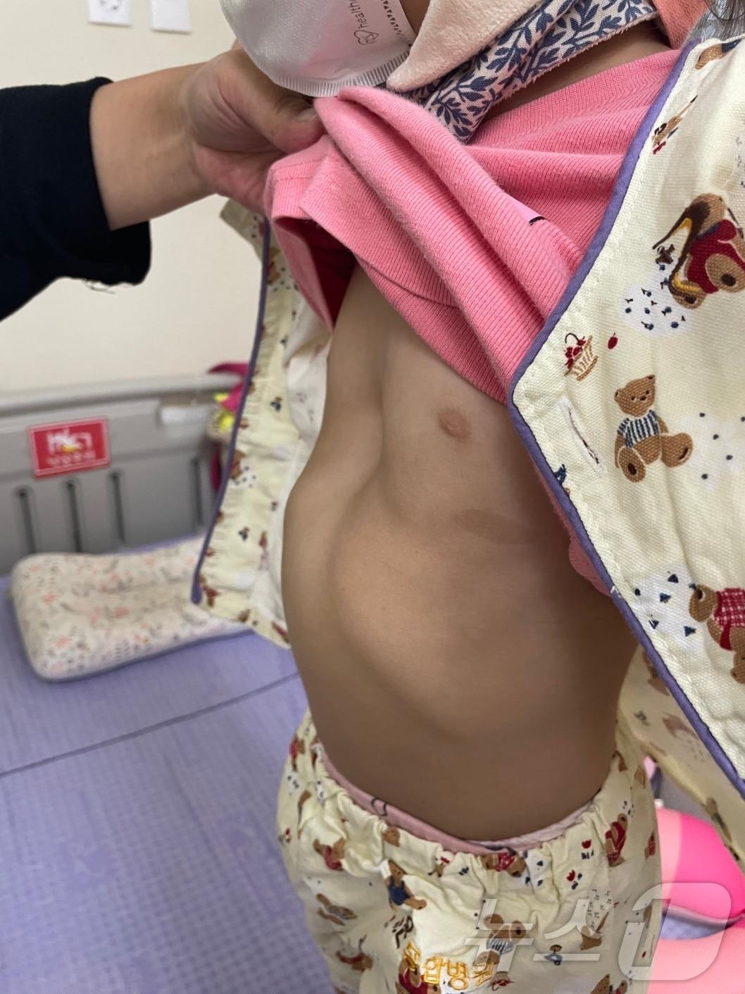 본문 이미지 - 부산온종합병원을 찾은 오목가슴 환자(온종합병원 제공)