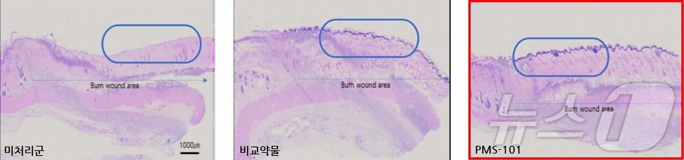본문 이미지 - 강스템바이오텍 계열사 프리모리스테라퓨틱스의 엑소좀 기반 화상치료제 PMS-101 효능 데이터. 화상 동물을 모델로 한 효력시험을 통해 PMS-101을 사용할 시 새로 성장하는 피부조직의 길이가 약물 미사용군 대비 45%, 현재 치료에 적용되는 약물 대비 23% 증가함을 확인했다.(강스템바이오텍 제공) /뉴스1 ⓒ News1 