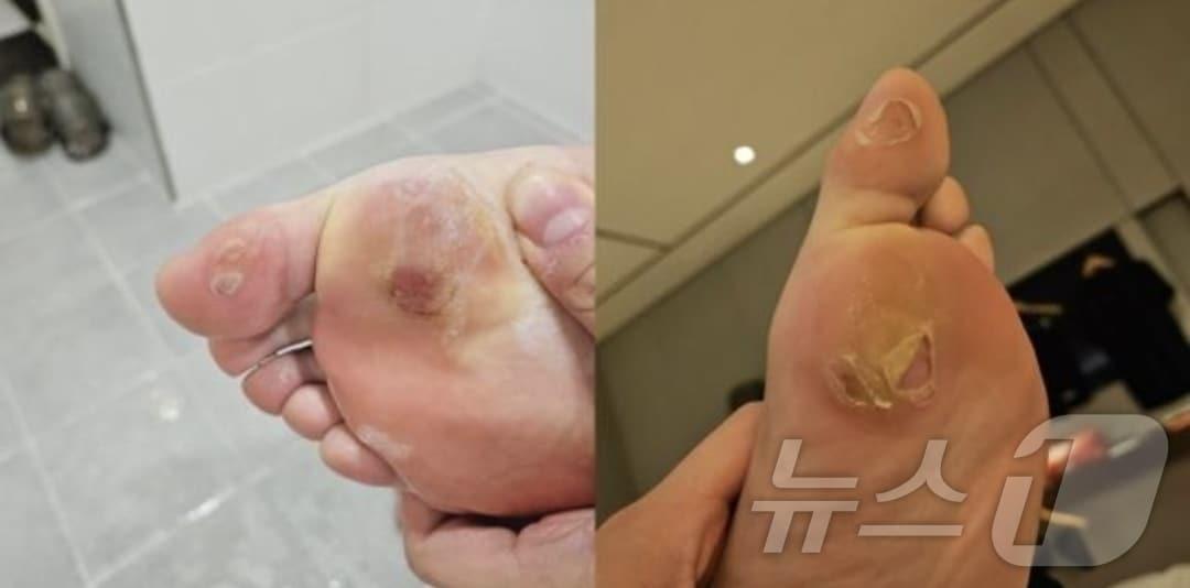 본문 이미지 - 물집 잡힌 안세영의 발 사진. 민형배 의원실 제공 ⓒ News1 