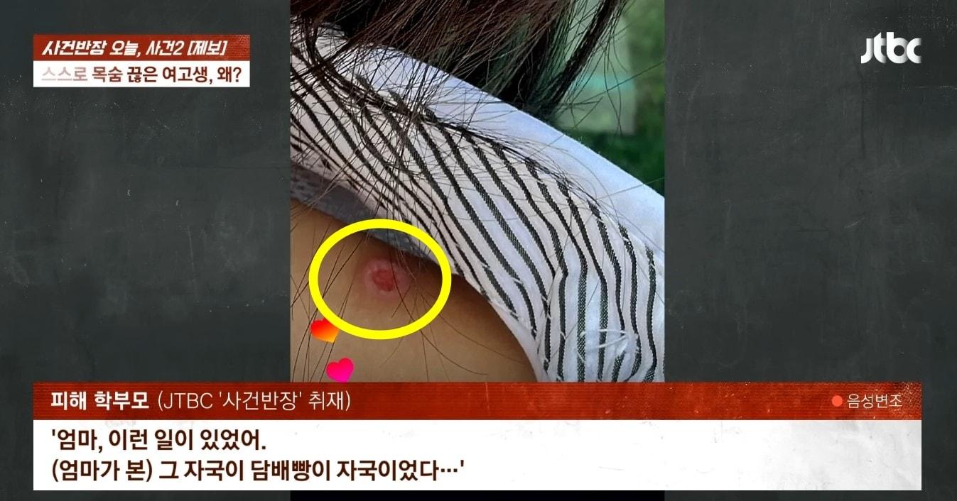 본문 이미지 - A 양 몸에 남아 있는 담배빵 자국. (JTBC '사건반장')