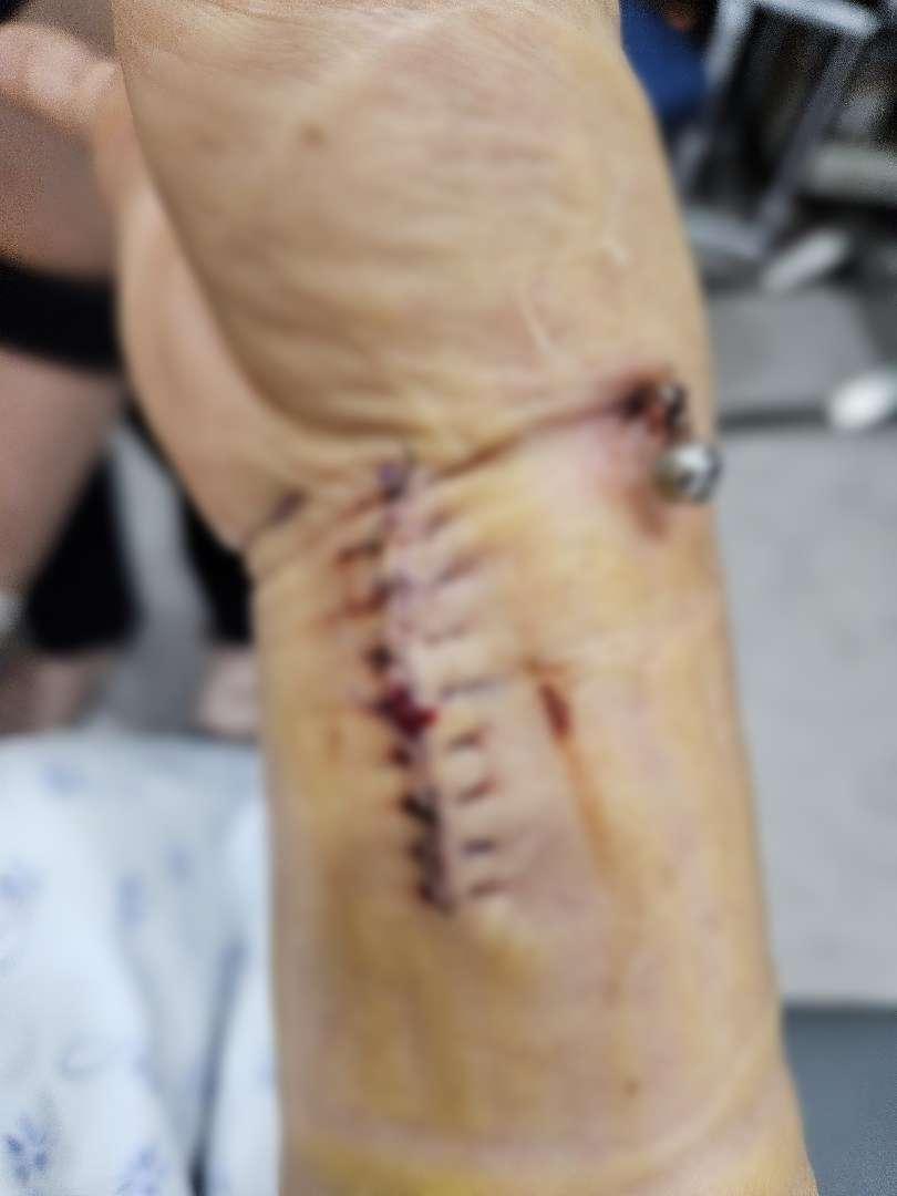 본문 이미지 - (수술 후 피해여성의 손목 사진. 보배드림 갈무리)