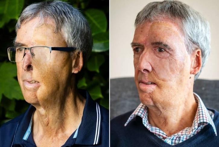 병원에서 3D 프린터 이식수술을 받고 난 뒤의 데이브 리저츠. 피플