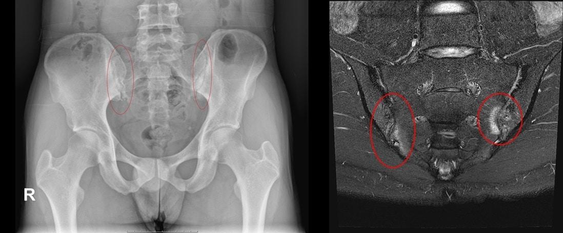 본문 이미지 - 강직척추염 검사 영상.(서울성모병원 제공)