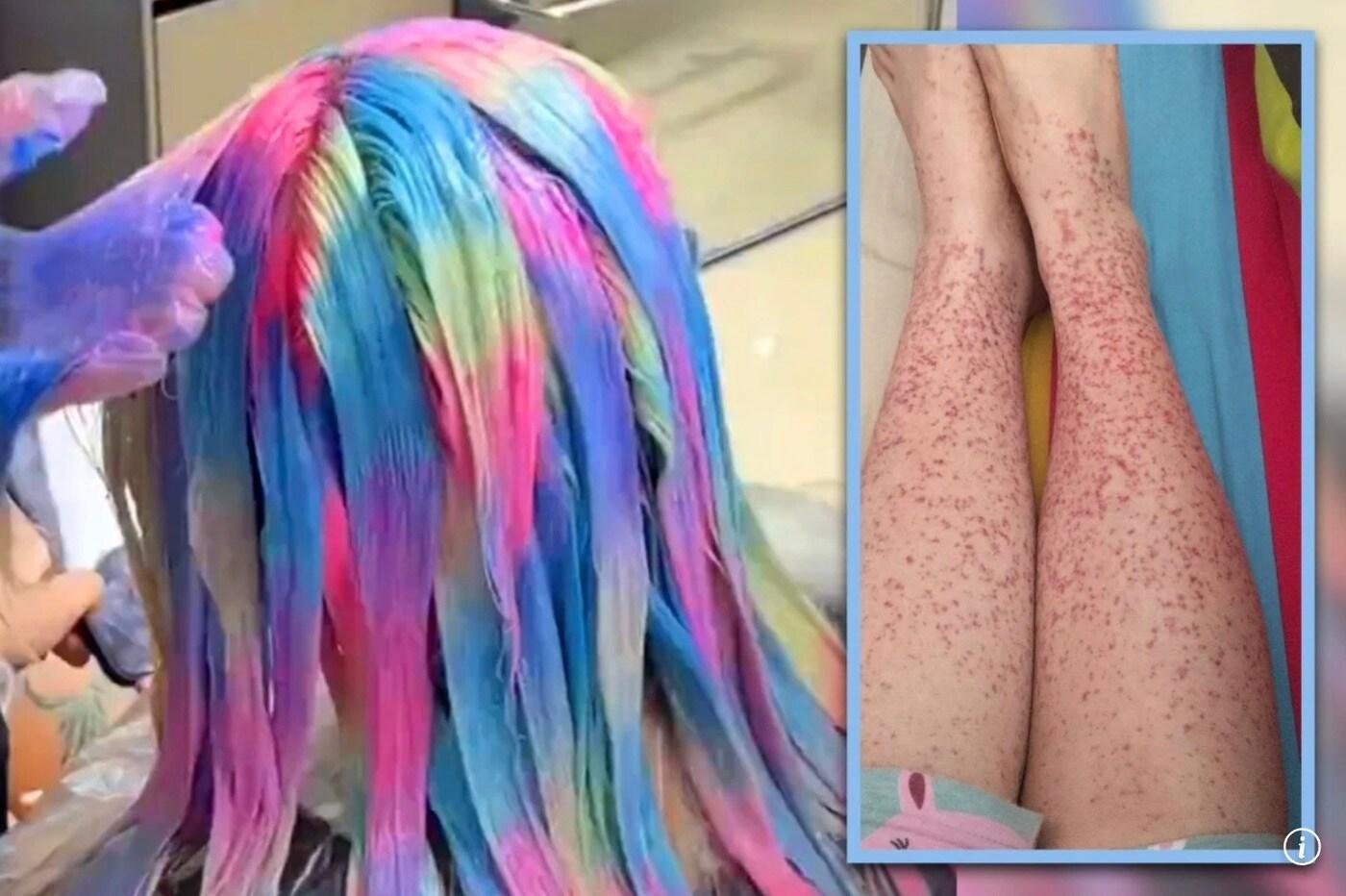 자신이 좋아하던 K팝 스타의 헤어스타일을 모방하려 매달 염색을 하다 신장 질환을 앓게 된 한 중국 여성. (사진=SCMP 갈무리)