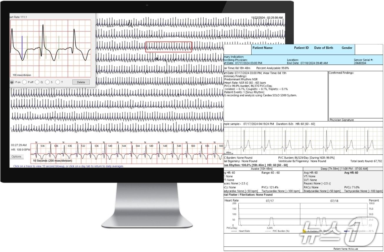 본문 이미지 - 카디악인사이트 부정맥 진단 소프트웨어 화면(드림텍 제공)