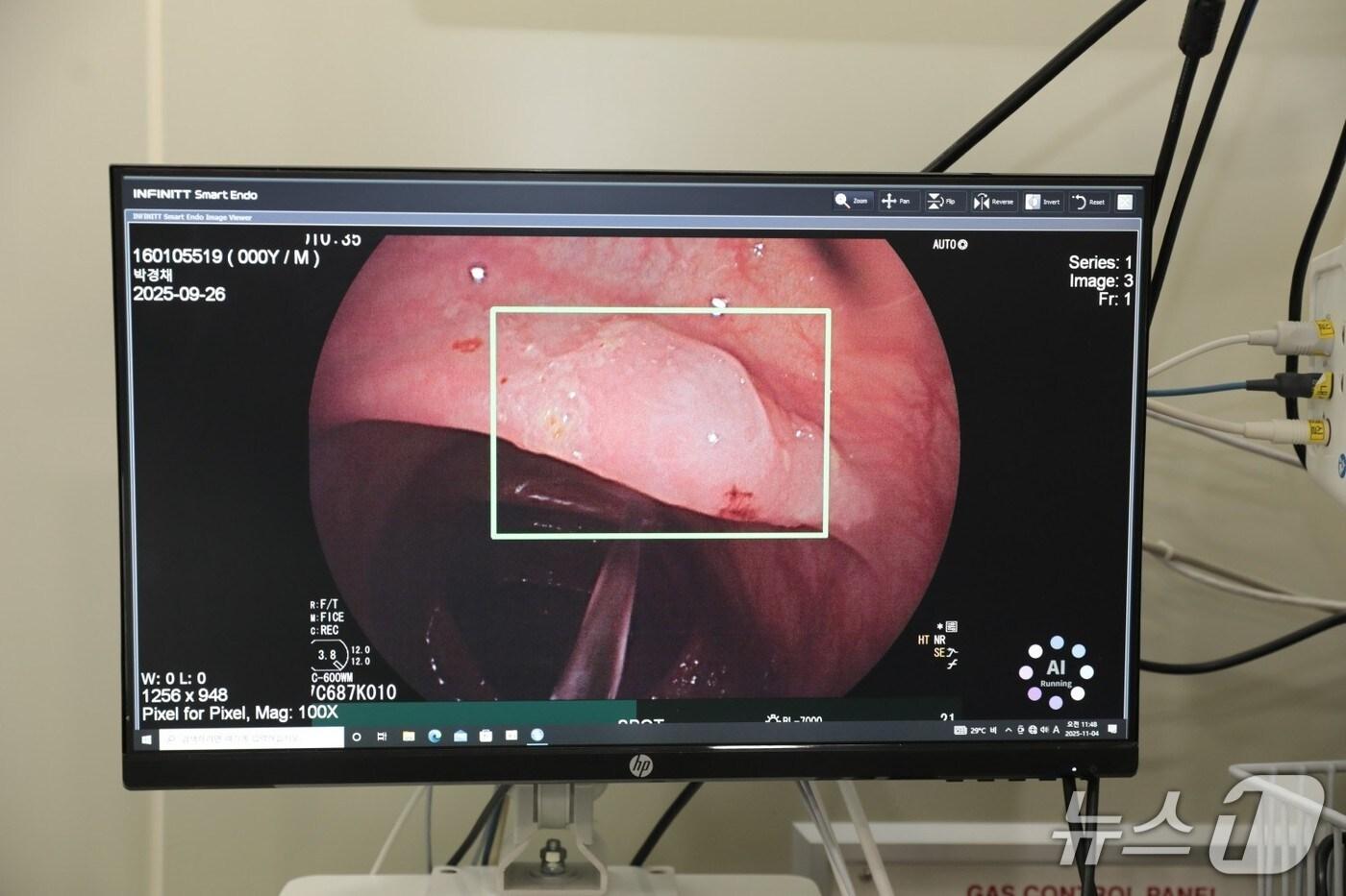 본문 이미지 - 대장내시경 검사를 할 때 AI(인공지능)를 활용하면 선종 검출률을 높일 수 있다는 연구결과가 나왔다. 사진은 AI 보조 대장내시경 모습.(한림대학교동탄성심병원 제공)