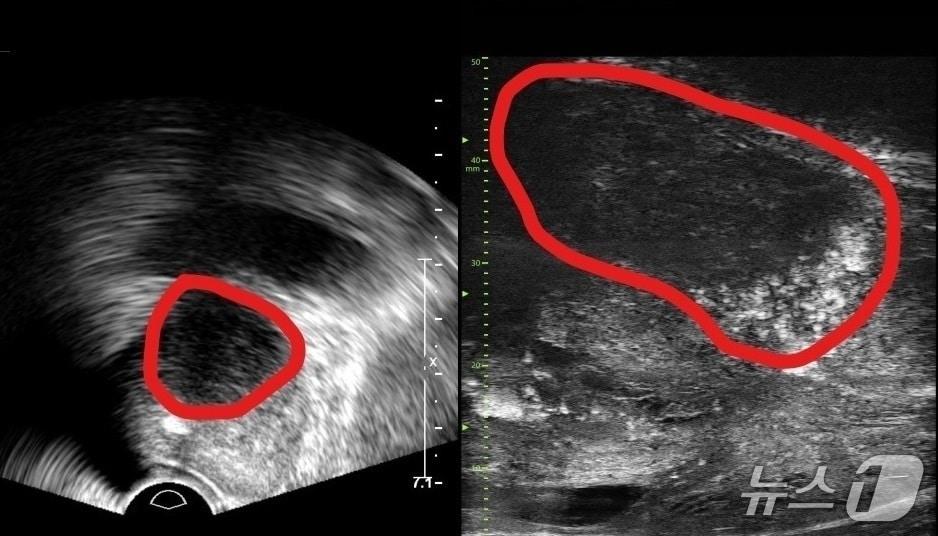 본문 이미지 - 기존 전립선 초음파 사진(왼쪽) 및 마이크로 초음파 사진(오른쪽). 기존 초음파는 전립선 부위(동그라미 친 부분)의 음영 차이로만 병변을 확인했지만, 마이크로 초음파는 높은 해상도를 통해 종양과 주변 조직의 모양까지 확인할 수 있다.(분당서울대병원 제공)