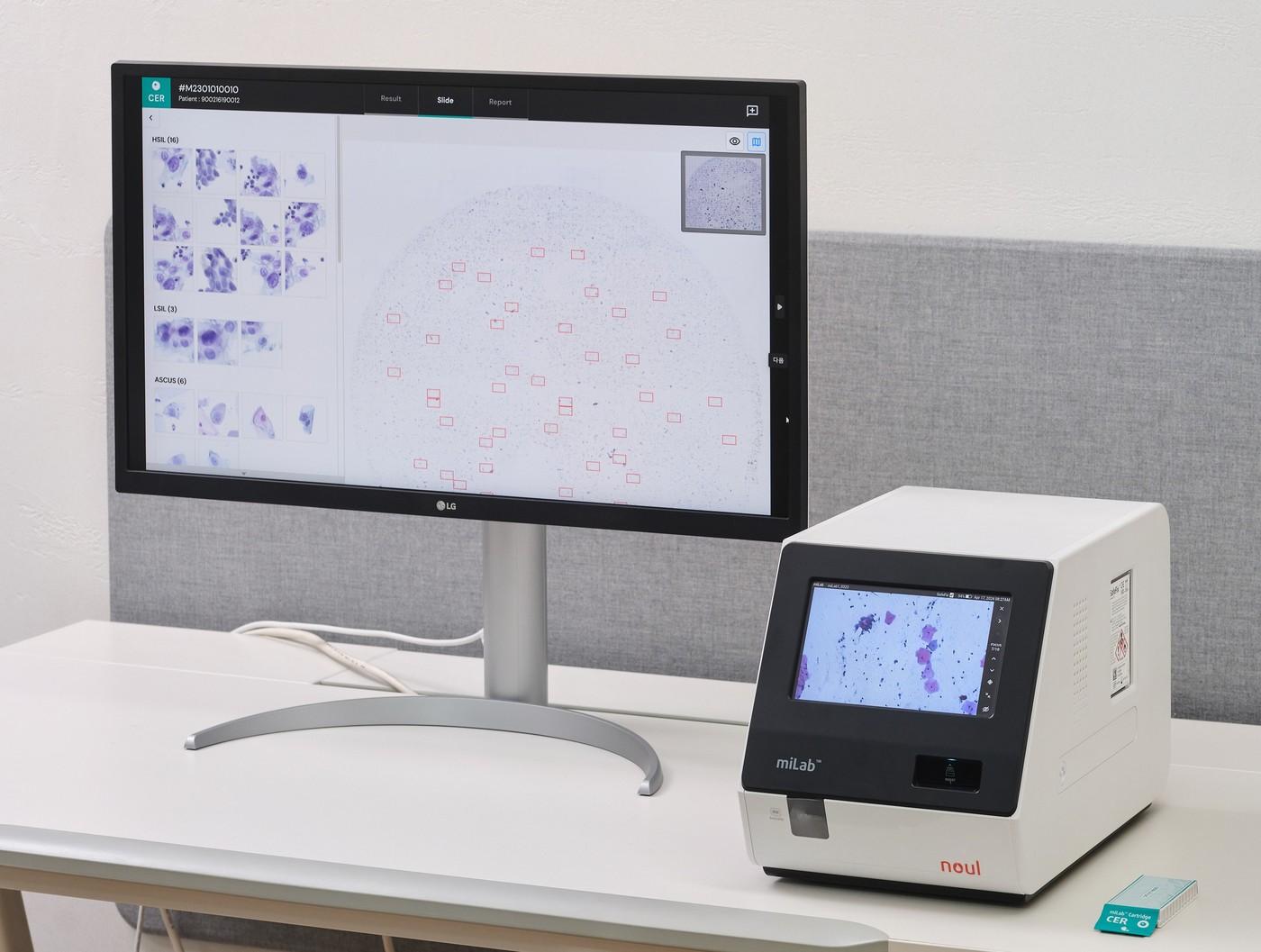 본문 이미지 - 노을 AI 기반 자궁경부암 진단 솔루션&#40;miLab CER&#41;. &#40;노을 제공&#41; 