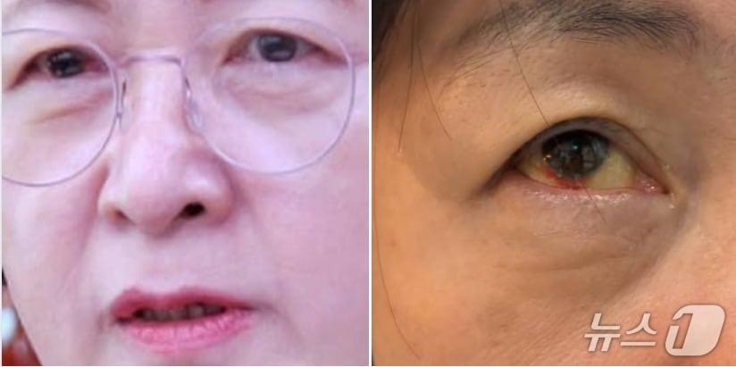 본문 이미지 - 추미애 국회 법사위원장이 3일 자신의 SNS에 '국민의힘 비협조로 2025법사위 진행이 너무 힘들어 안구 실핏줄이 터지고 귀각 먹먹해 져 병원을 찾았다'며 충혈된 눈 사진을 올렸다. (SNS 갈무리) ⓒ 뉴스1 