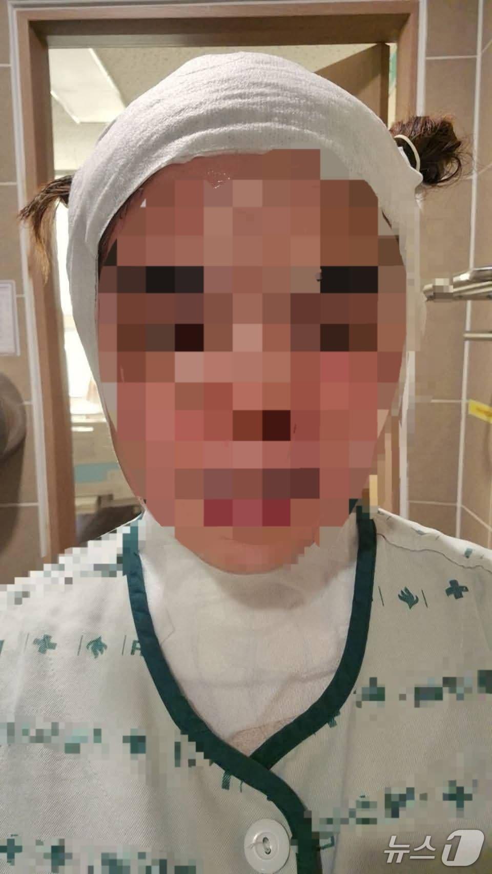 본문 이미지 - 화상 입은 30대 태국인 여성&#40;페이스북 갈무리. 재판매 및 DB 금지&#41;/뉴스1 