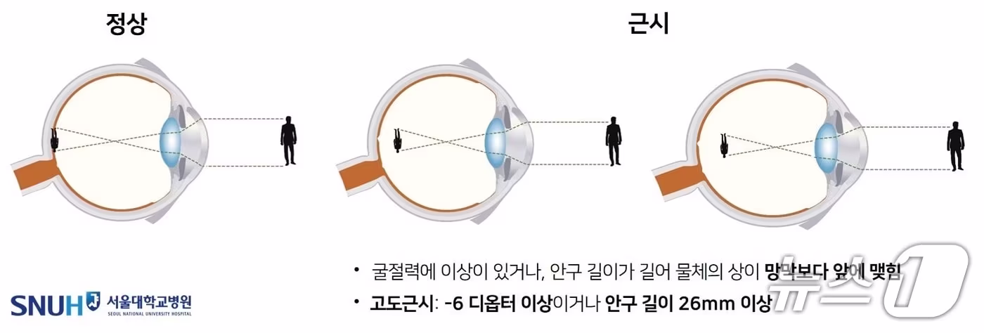 근시는 눈으로 들어온 빛이 망막보다 앞에 맺혀 멀리 있는 물체를 선명하게 보지 못하는 상태다. 사진은 고도 근시의 정의.(서울대병원 제공)