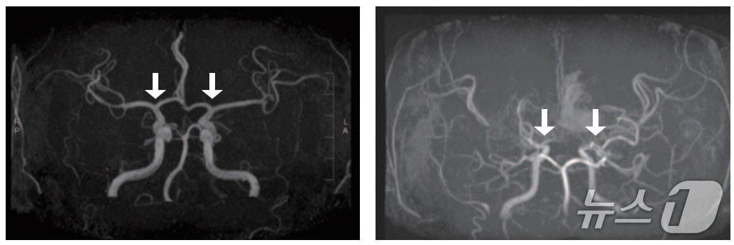 본문 이미지 - &#40;왼쪽부터&#41;정상 및 모야모야병 환자의 뇌혈관.&#40;서울대병원 제공&#41;