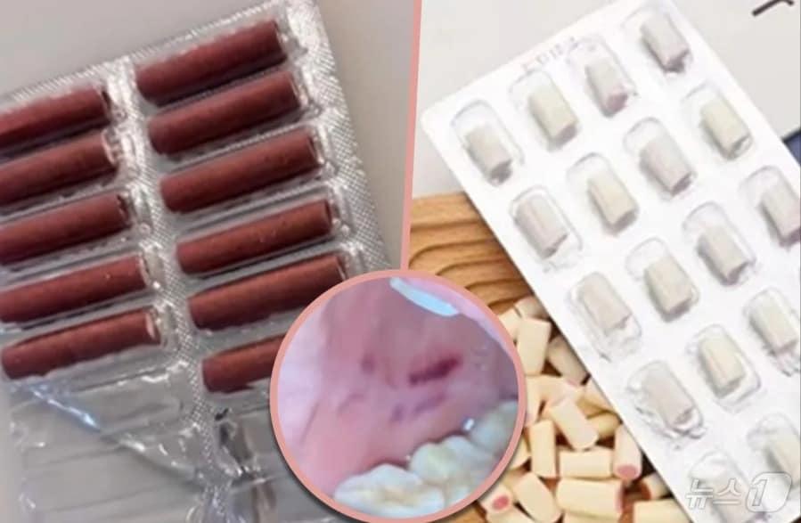 본문 이미지 - 관련 시각물. 동그라미 부분이 입안의 상처. - SCMP 갈무리