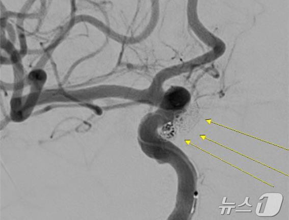 본문 이미지 - 환자 A 씨의 파열된 대뇌동맥류 코일색전술 사진(센텀종합병원 재판매 및 DB금지)