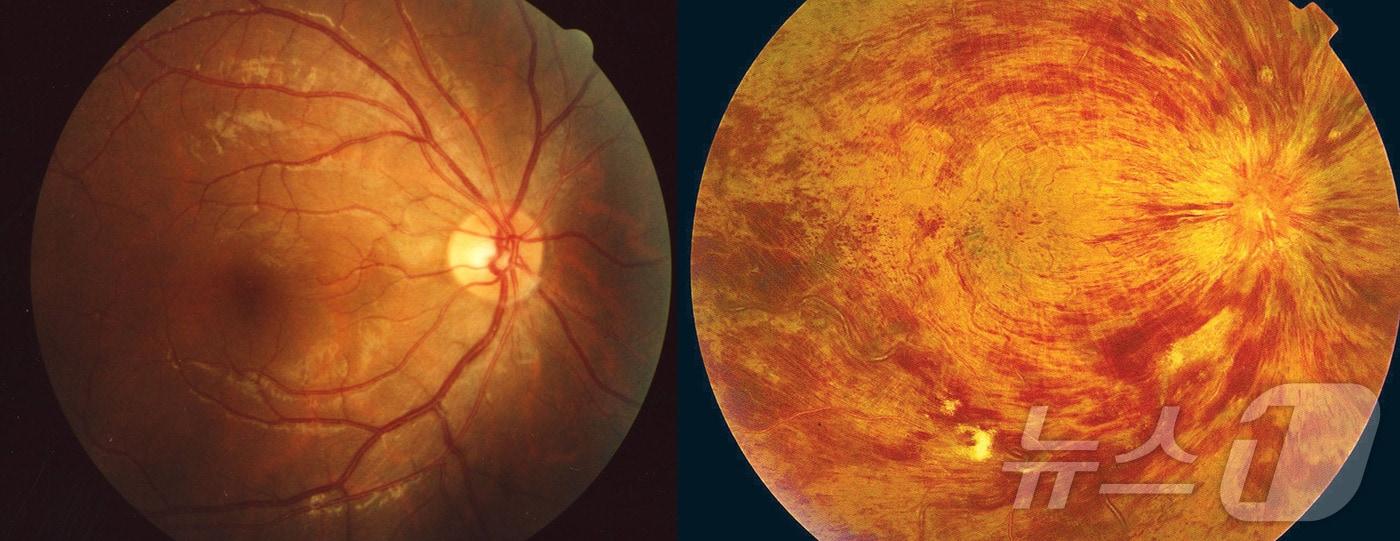 (왼쪽) 정상 안저와 망막혈관폐쇄 환자의 안저 (순청향대 부천병원 제공) 2025.2.18/뉴스1