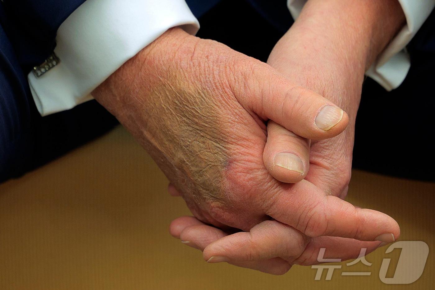 본문 이미지 - 도널드 트럼프 미국 대통령 손에 멍이 든 모습. (출처=엑스 갈무리) 2025.2.26./뉴스1
