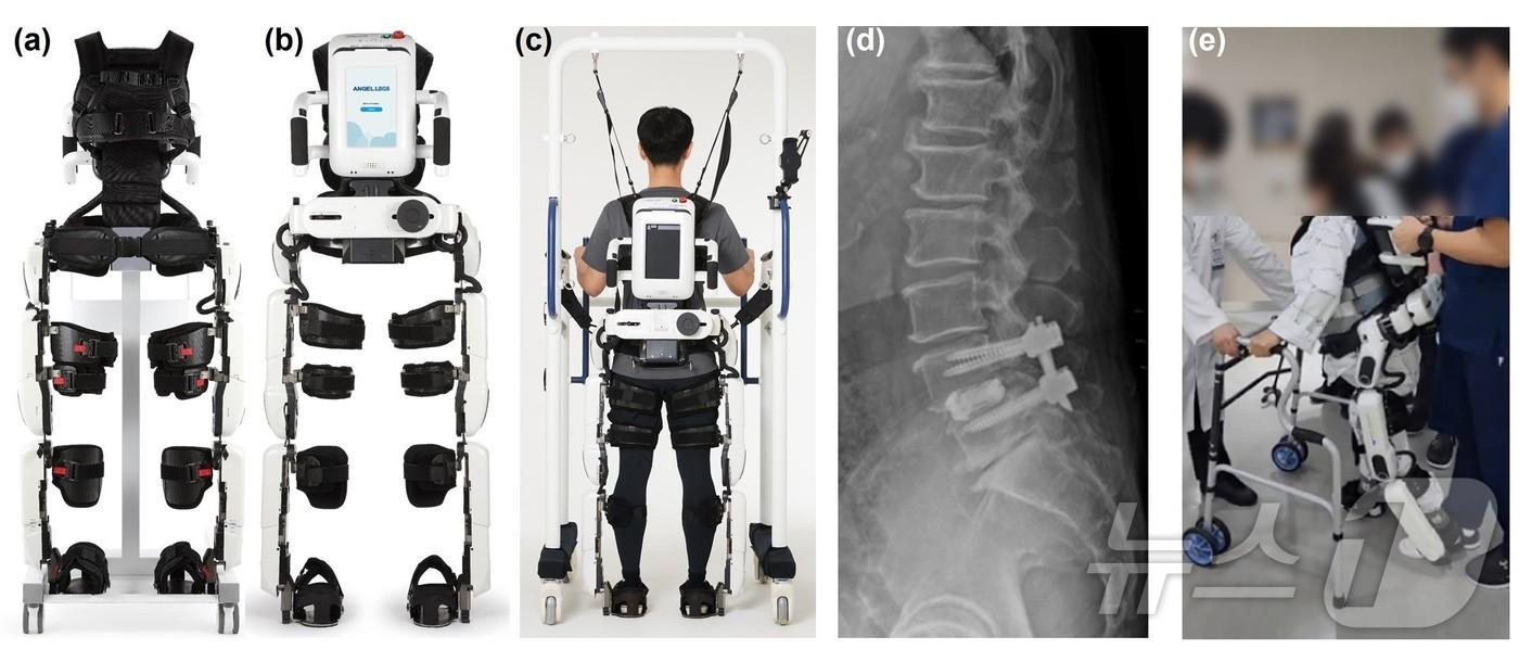 로봇 보조 보행 훈련 개념 설명 사진. &#40;a&#41; 보행 보조 훈련 로봇 전면 및 &#40;b&#41; 후면. &#40;c&#41; 로봇을 활용해 보행 보조 훈련 중인 환자 후면. &#40;d&#41; 측면 요추 방사선 사진과 &#40;e&#41;척추 보조기를 착용하고 보행 보조 로봇 훈련을 받는 환자 모습./연세대학교 강남세브란스 병원 제공