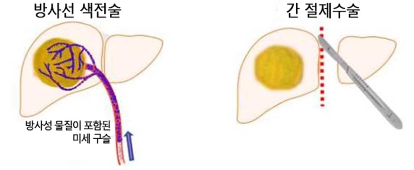 방사선색전술과 간 절제수술 비교.&#40;서울대병원 제공&#41;
