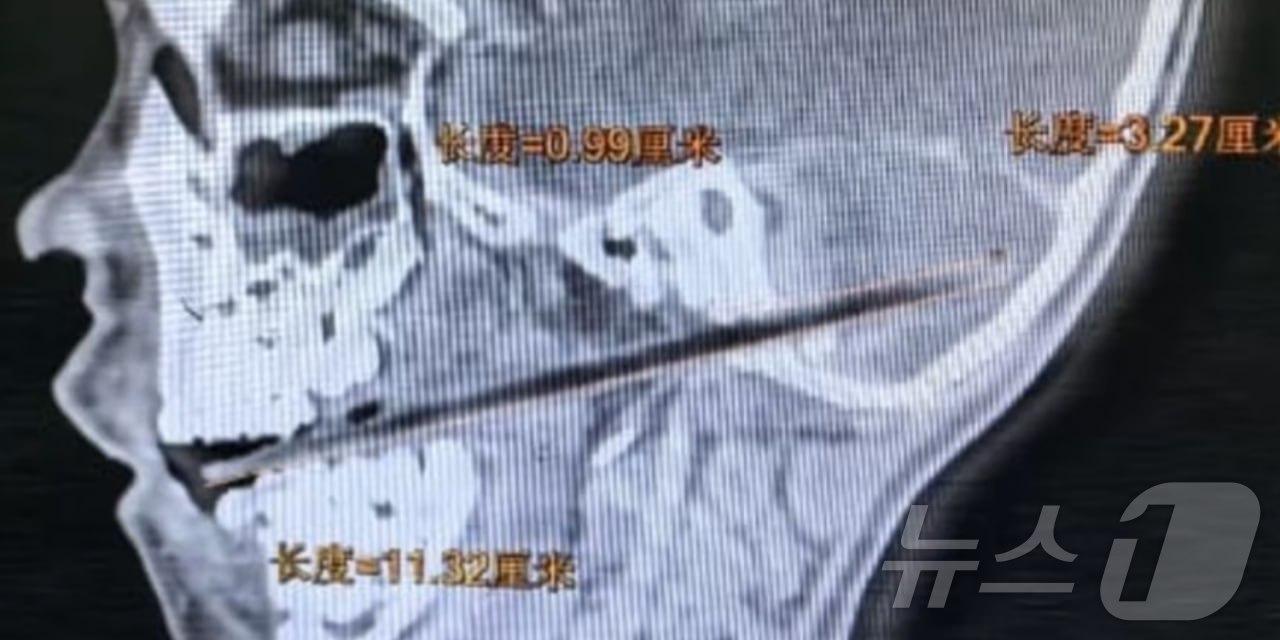 본문 이미지 - 중국에서 사탕을 먹던 6살 아이가 넘어져 사탕 막대가 뇌까지 관통하는 사고가 발생했다. (출처=머스트쉐어 뉴스 엑스) 2025.3.30./뉴스1