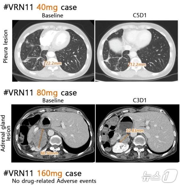 본문 이미지 - 보로노이 4세대 폐암 신약 후보물질 'VRN11' 용량별 투여 결과. 병변이 줄어 들고 별다른 부작용이 확인되지 않았다.(보로노이 제공)/뉴스1