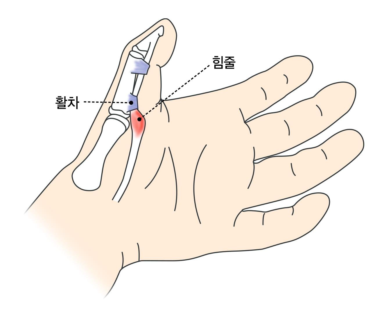 본문 이미지 - 방아쇠 손가락.(강동경희대병원 제공)