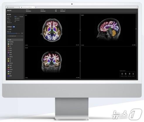 본문 이미지 - 뉴로핏이 개발한 AI 기반 뇌 질환 진단 보조 소프트웨어 &#39;뉴로핏 아쿠아&#39; 활용 모습.&#40;뉴로핏 제공&#41;/뉴스1