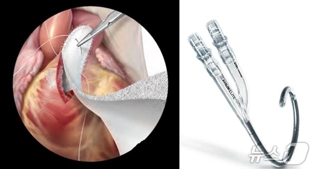 본문 이미지 - 희소·긴급도입 필요 의료기기 2종. 심혈관용 패치(왼쪽)와 단일형 ECMO용 카테터(한국의료기기안전정보원 제공)