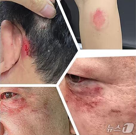 본문 이미지 - 얼굴 부위에 폭행 흔적이 있는 평택지역 지방일간지 소속 기자 얼굴(유튜브 캡처)