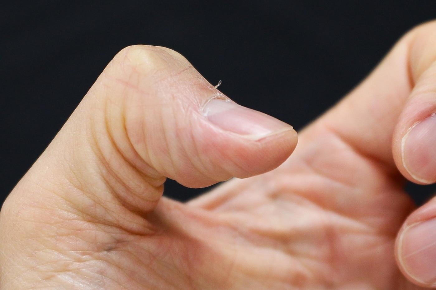 조갑주위염을 예방하기 위해서는 거스러미가 발생하지 않게 청결과 보습에 각별히 신경 써야 한다.(고려대안산병원 제공)