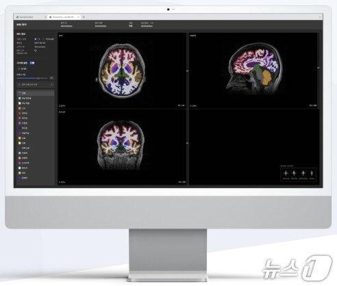 본문 이미지 - 뉴로핏이 개발한 AI 기반 뇌 질환 진단 보조 소프트웨어 &#39;뉴로핏 아쿠아&#39; 활용 모습.&#40;뉴로핏 제공&#41;