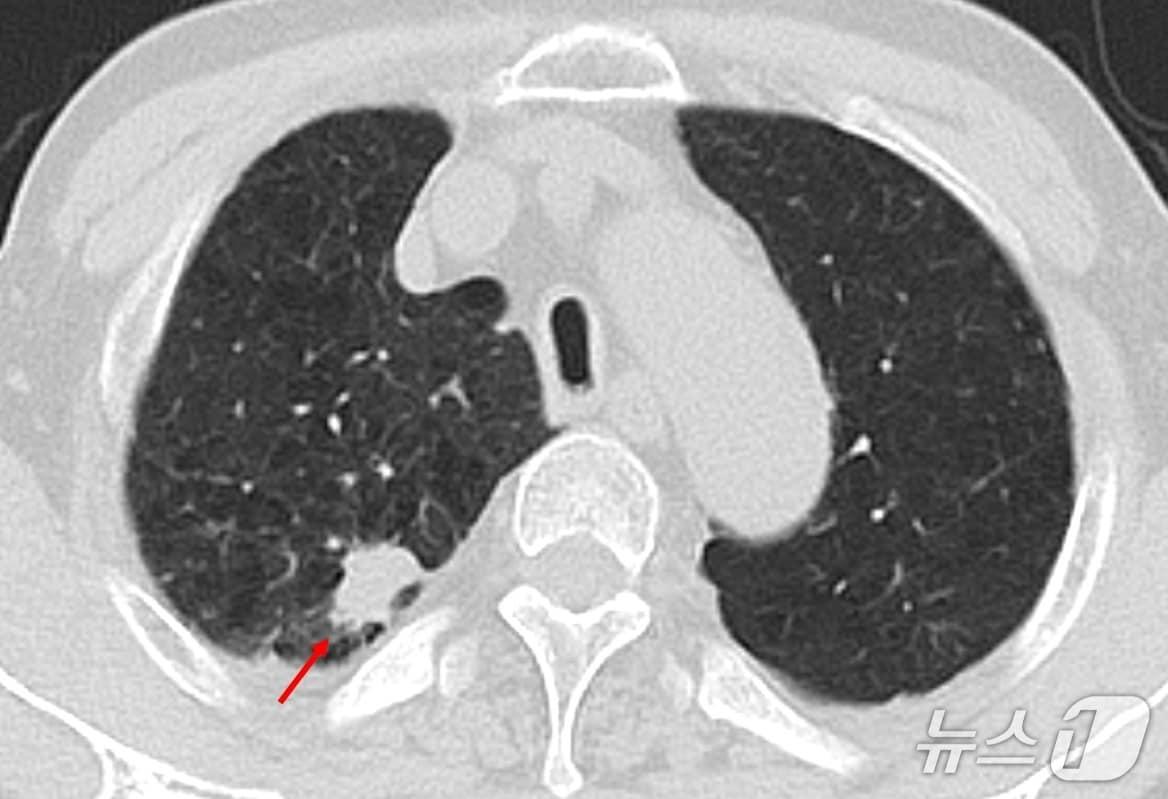 본문 이미지 - 저선량 흉부 CT 검사에서 폐결절 확인 사진&#40;한림대학교동탄성심병원 제공&#41;