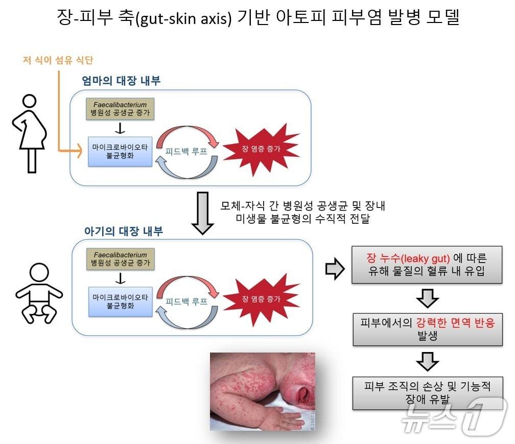 본문 이미지 - 병원성 공생균과 식이섬유 부족에 따른 아토피 피부염 발병 모델(한국연구재단 제공) /뉴스1