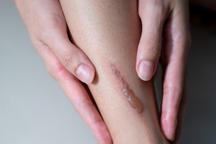 본문 이미지 - 비대성 흉터.(한림대한강성심병원 제공)