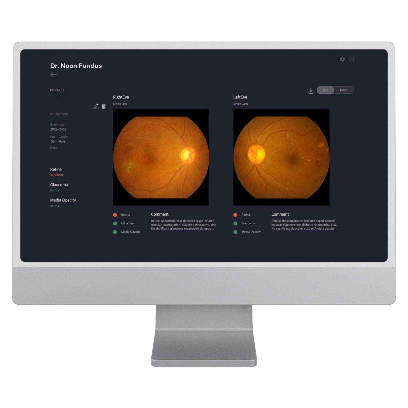 본문 이미지 -  메디웨일의 안질환 진단보조 AI 솔루션 '닥터눈 펀더스'. (메디웨일 제공)