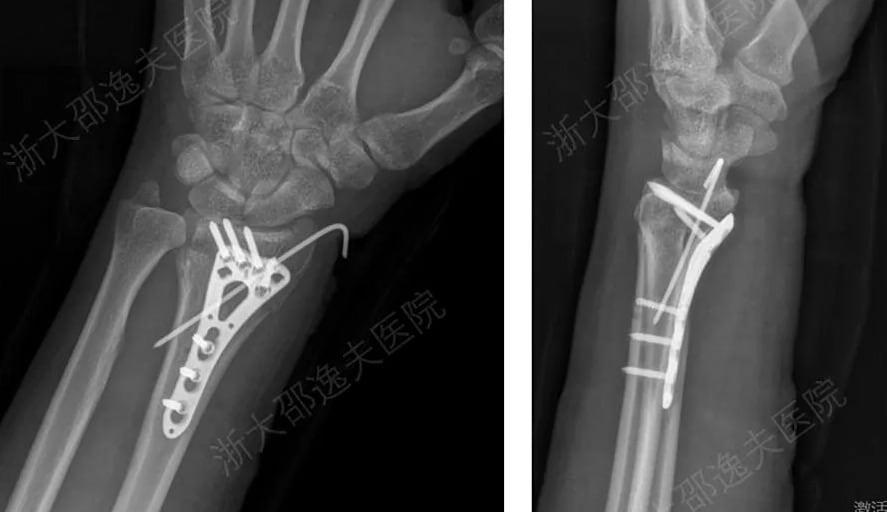 본문 이미지 -  기존 금속 고정으로 손목 골절을 치료한 모습(Pandaily 갈무리)